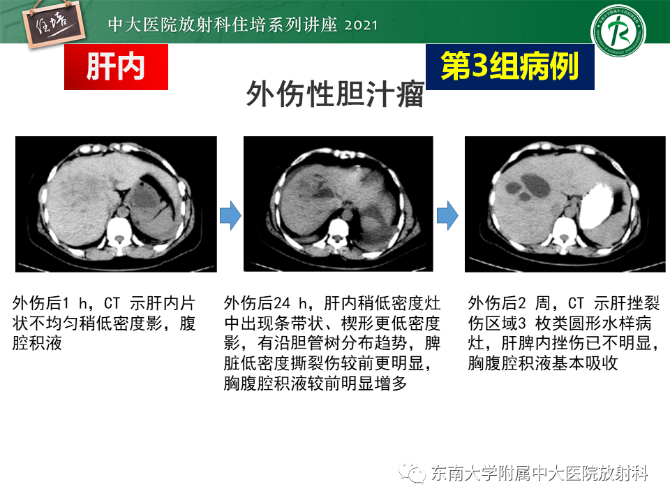 影像PPT - 【PPT】认识胆道系统影像常见漏诊、误诊病变-17
