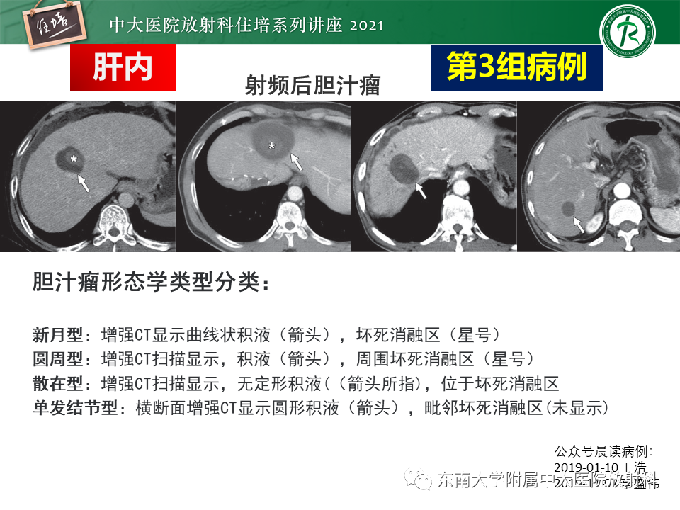影像PPT - 【PPT】认识胆道系统影像常见漏诊、误诊病变-18