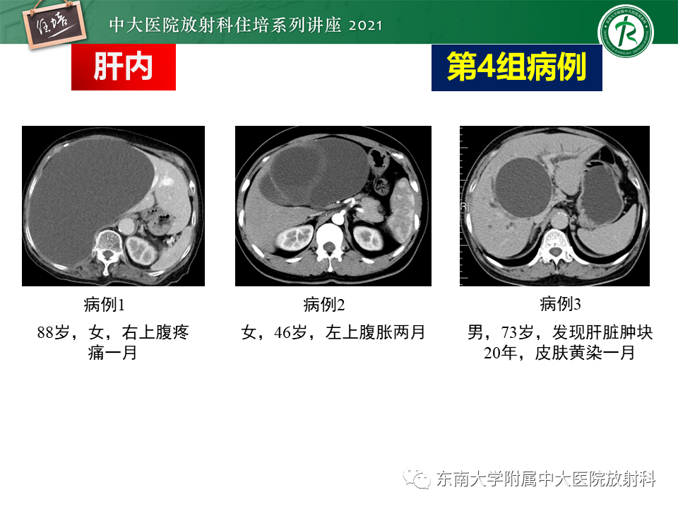 影像PPT - 【PPT】认识胆道系统影像常见漏诊、误诊病变-19