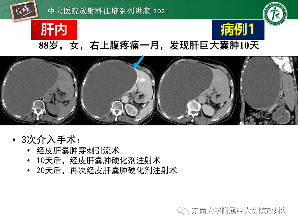 影像PPT - 【PPT】认识胆道系统影像常见漏诊、误诊病变-20