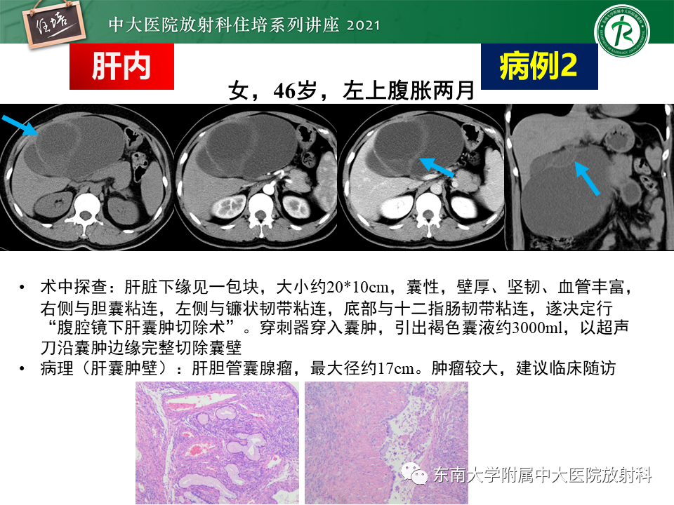 影像PPT - 【PPT】认识胆道系统影像常见漏诊、误诊病变-21