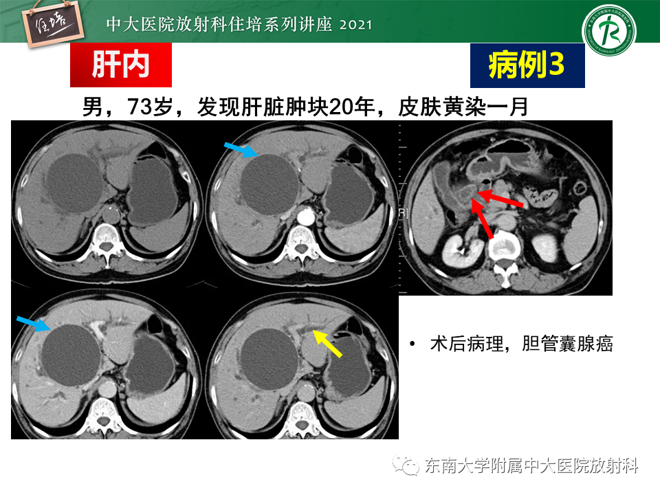 影像PPT - 【PPT】认识胆道系统影像常见漏诊、误诊病变-22