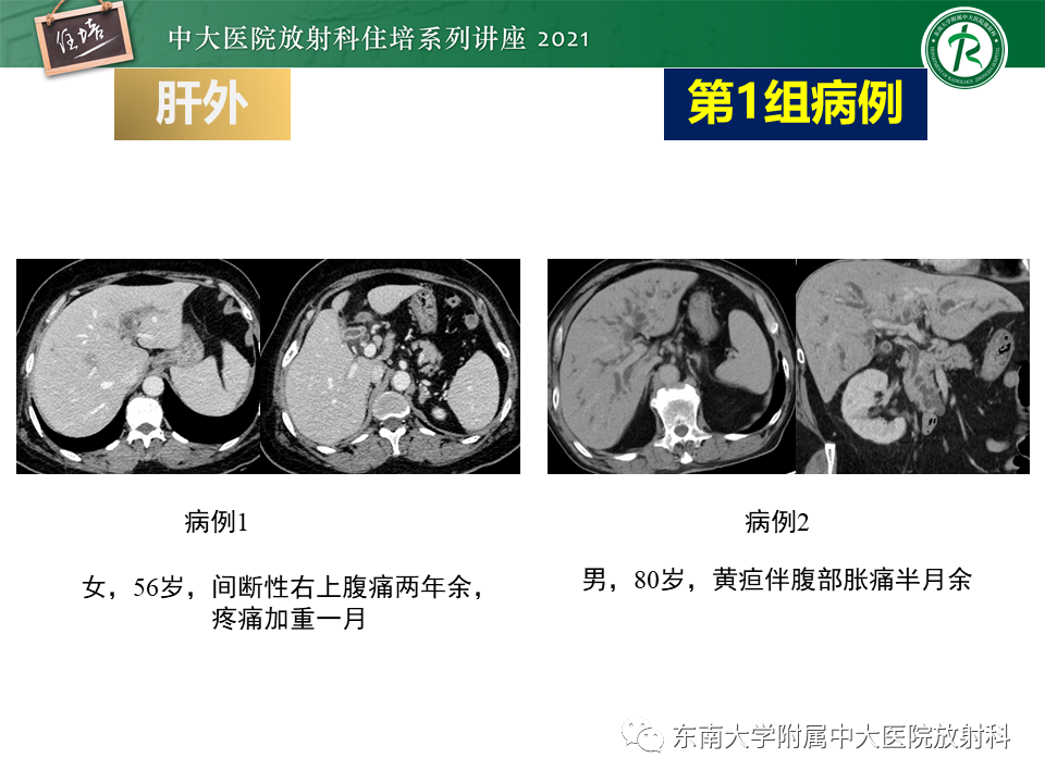 影像PPT - 【PPT】认识胆道系统影像常见漏诊、误诊病变-25