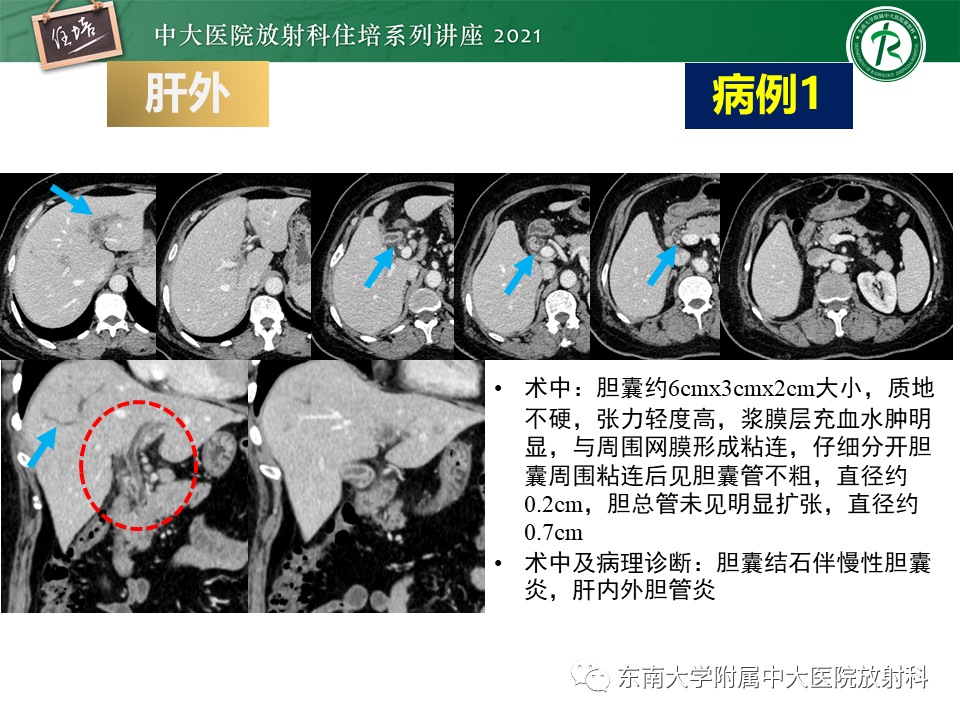 影像PPT - 【PPT】认识胆道系统影像常见漏诊、误诊病变-26