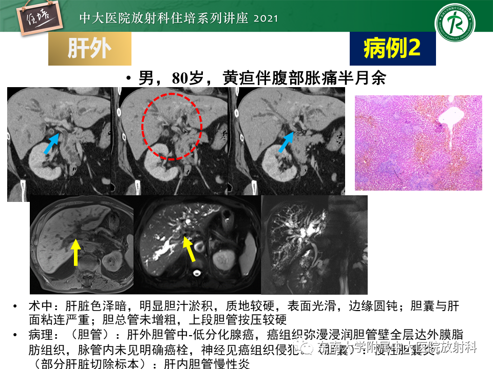 影像PPT - 【PPT】认识胆道系统影像常见漏诊、误诊病变-27