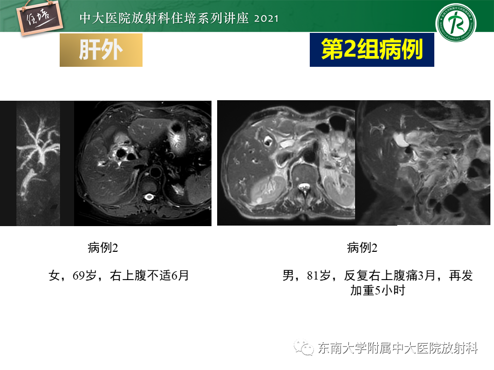影像PPT - 【PPT】认识胆道系统影像常见漏诊、误诊病变-29