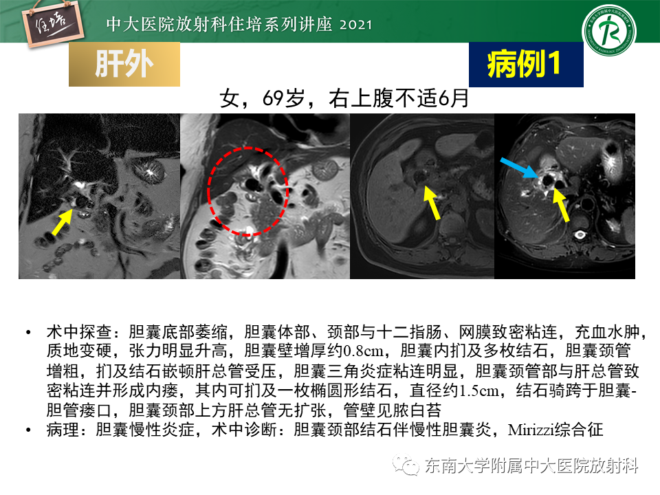影像PPT - 【PPT】认识胆道系统影像常见漏诊、误诊病变-30