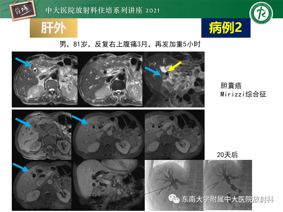影像PPT - 【PPT】认识胆道系统影像常见漏诊、误诊病变-31