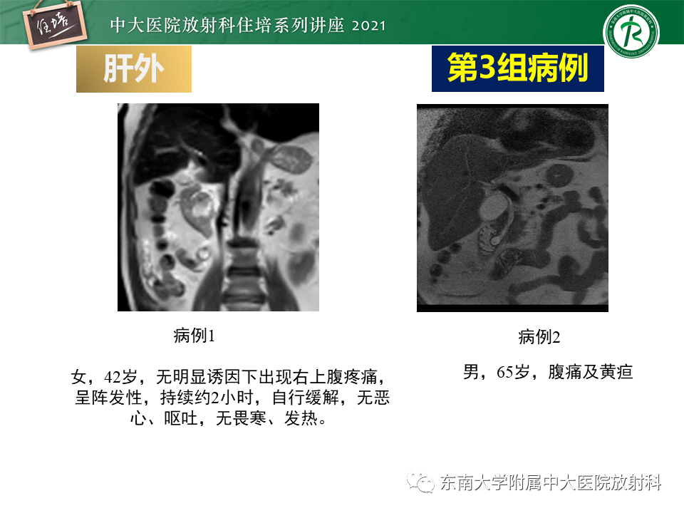 影像PPT - 【PPT】认识胆道系统影像常见漏诊、误诊病变-33