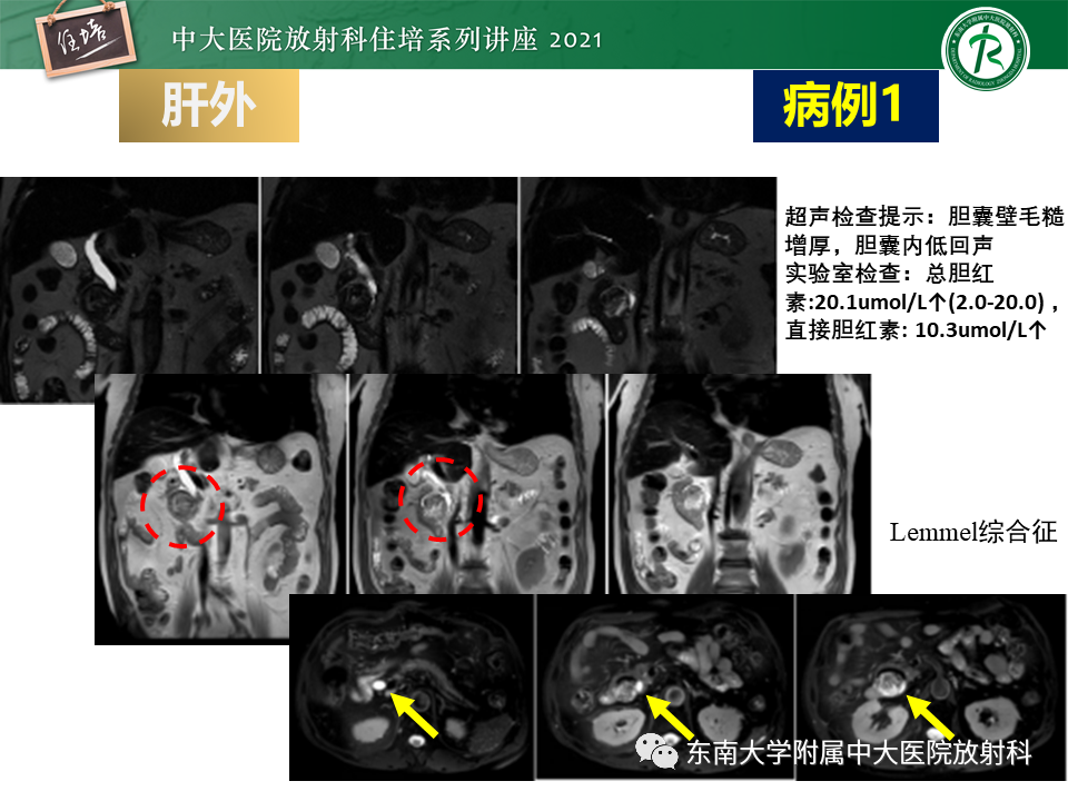 影像PPT - 【PPT】认识胆道系统影像常见漏诊、误诊病变-34