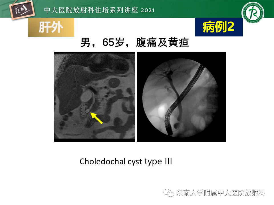 影像PPT - 【PPT】认识胆道系统影像常见漏诊、误诊病变-35