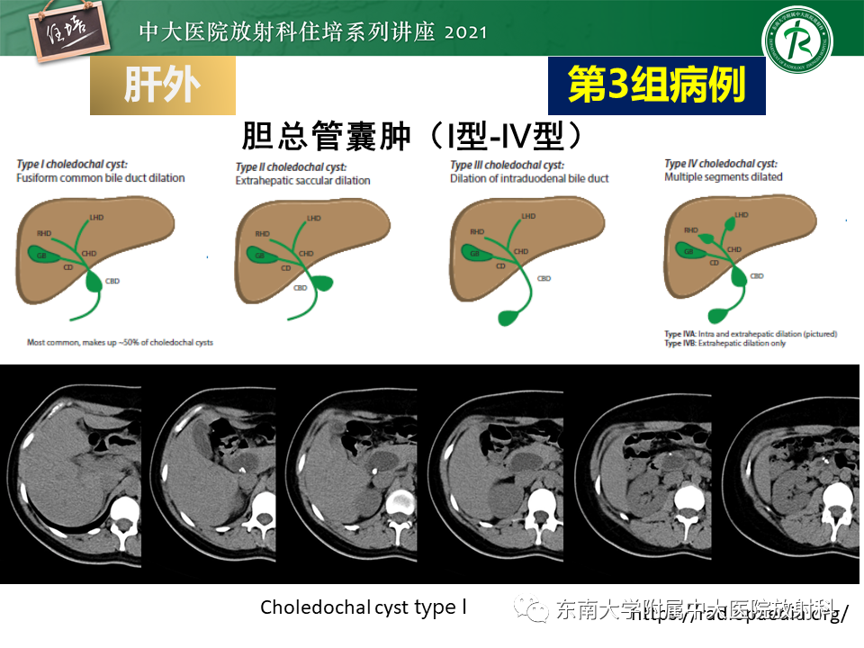 影像PPT - 【PPT】认识胆道系统影像常见漏诊、误诊病变-37