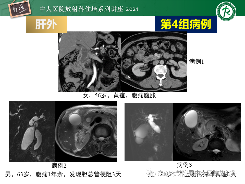 影像PPT - 【PPT】认识胆道系统影像常见漏诊、误诊病变-38