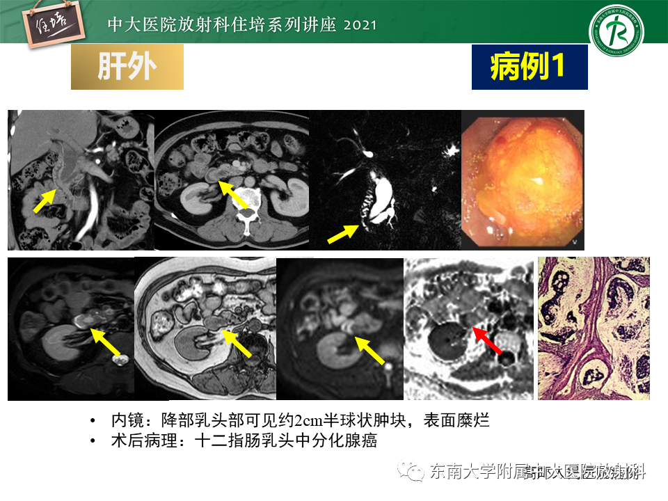 影像PPT - 【PPT】认识胆道系统影像常见漏诊、误诊病变-39