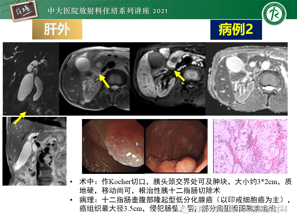 影像PPT - 【PPT】认识胆道系统影像常见漏诊、误诊病变-40