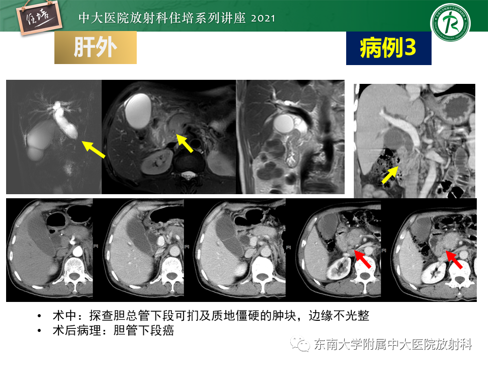 影像PPT - 【PPT】认识胆道系统影像常见漏诊、误诊病变-41