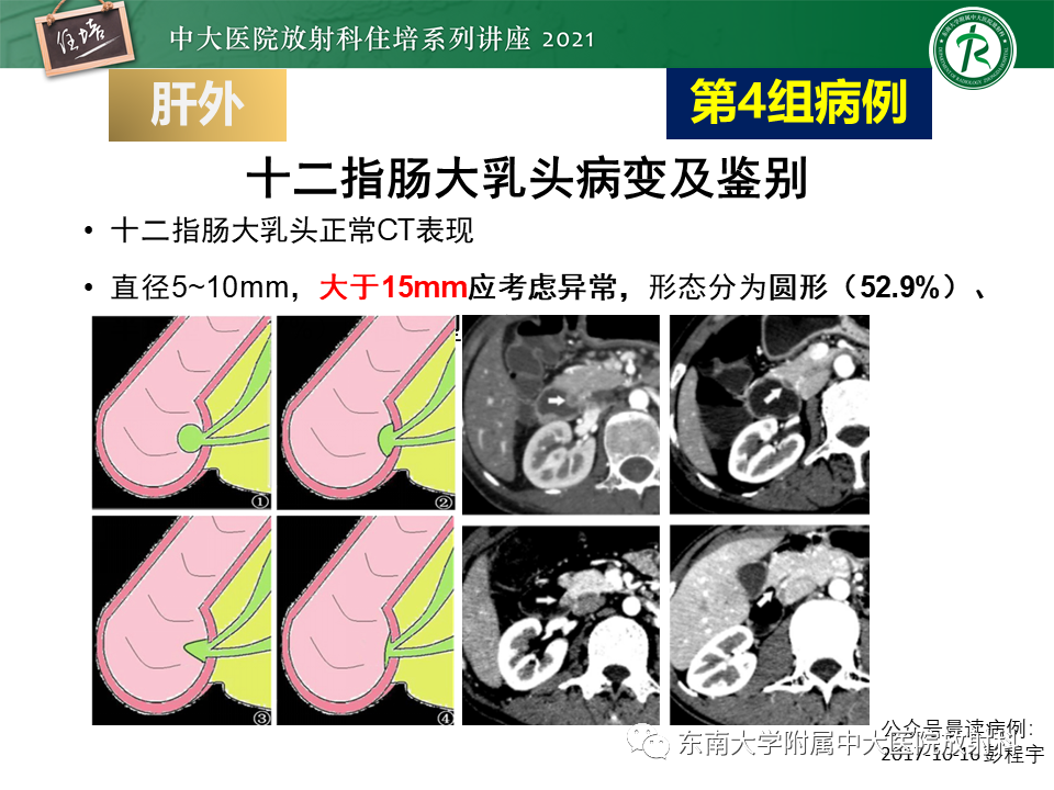 影像PPT - 【PPT】认识胆道系统影像常见漏诊、误诊病变-43