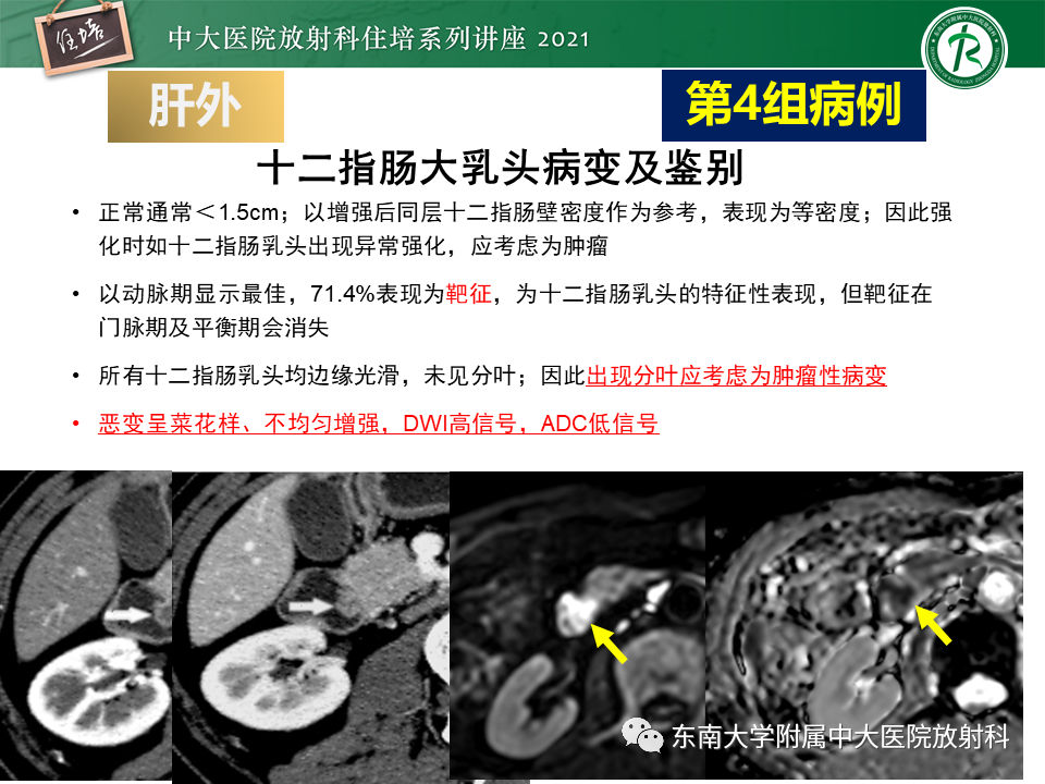 影像PPT - 【PPT】认识胆道系统影像常见漏诊、误诊病变-44