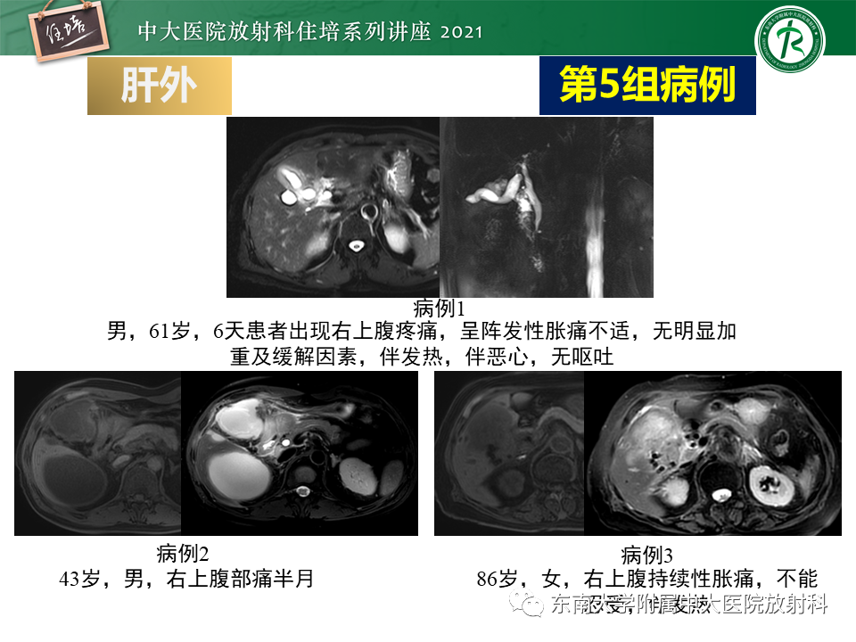 影像PPT - 【PPT】认识胆道系统影像常见漏诊、误诊病变-46