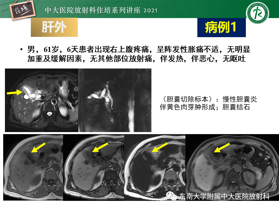 影像PPT - 【PPT】认识胆道系统影像常见漏诊、误诊病变-47