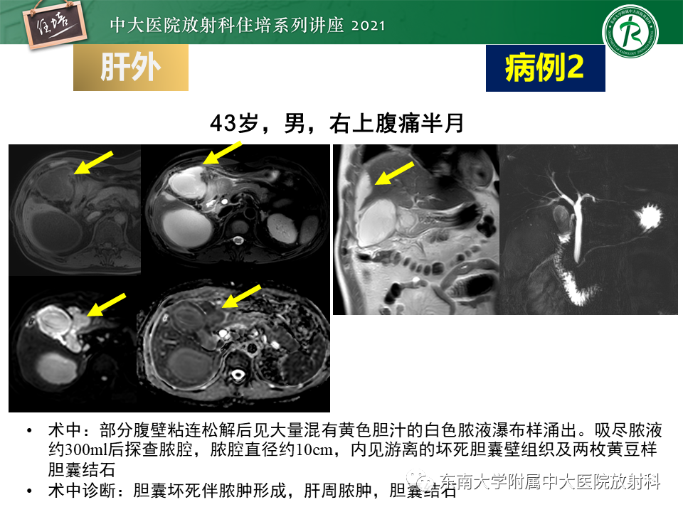 影像PPT - 【PPT】认识胆道系统影像常见漏诊、误诊病变-48