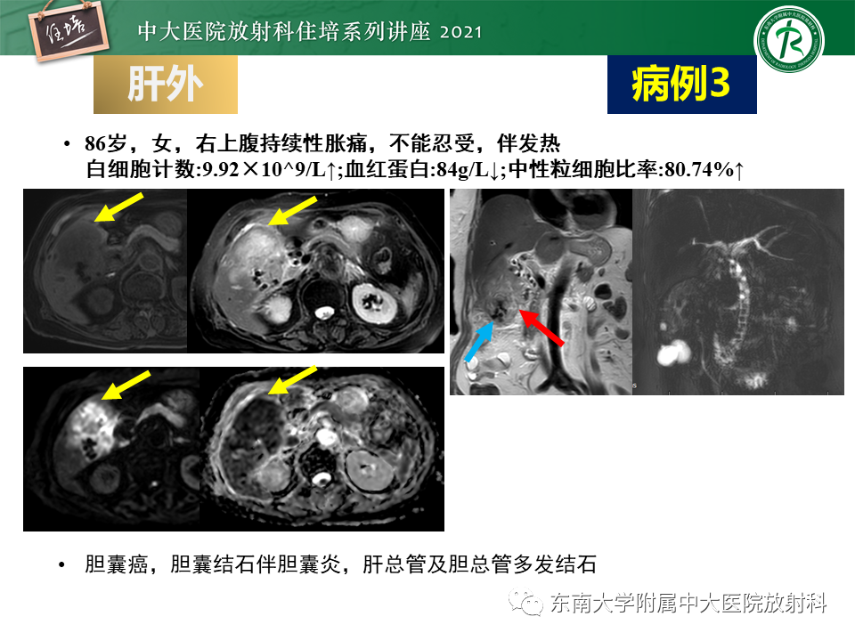影像PPT - 【PPT】认识胆道系统影像常见漏诊、误诊病变-49