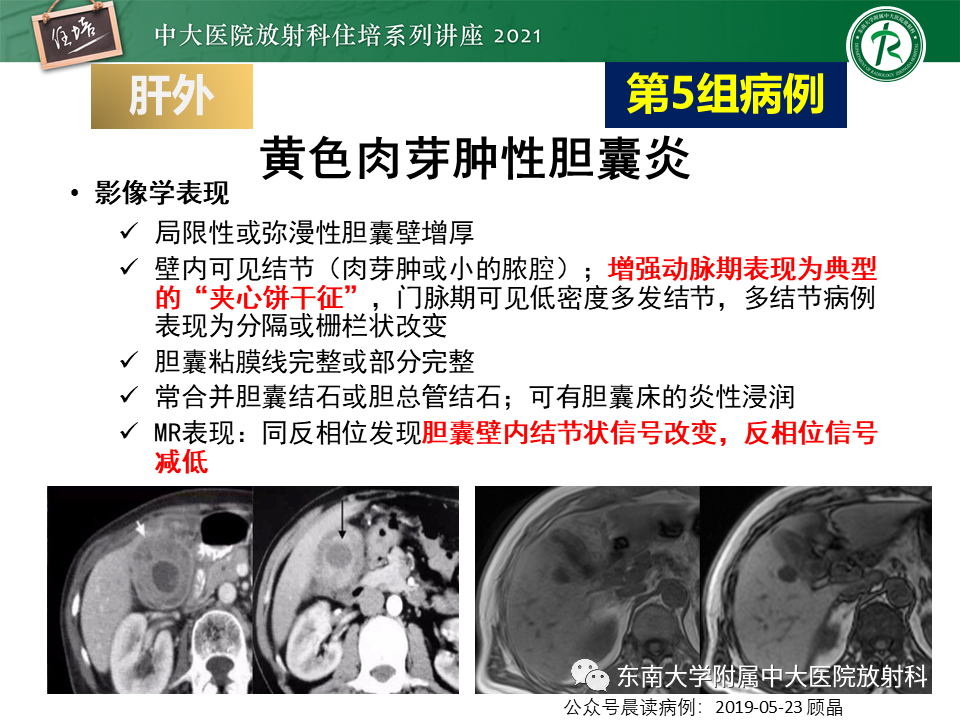 影像PPT - 【PPT】认识胆道系统影像常见漏诊、误诊病变-51