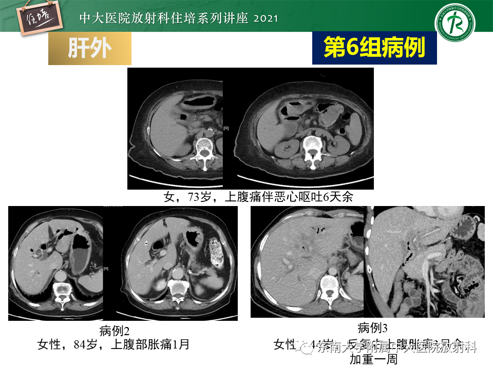 影像PPT - 【PPT】认识胆道系统影像常见漏诊、误诊病变-54