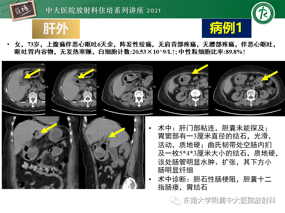 影像PPT - 【PPT】认识胆道系统影像常见漏诊、误诊病变-55