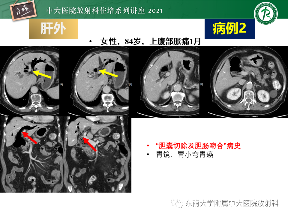 影像PPT - 【PPT】认识胆道系统影像常见漏诊、误诊病变-56