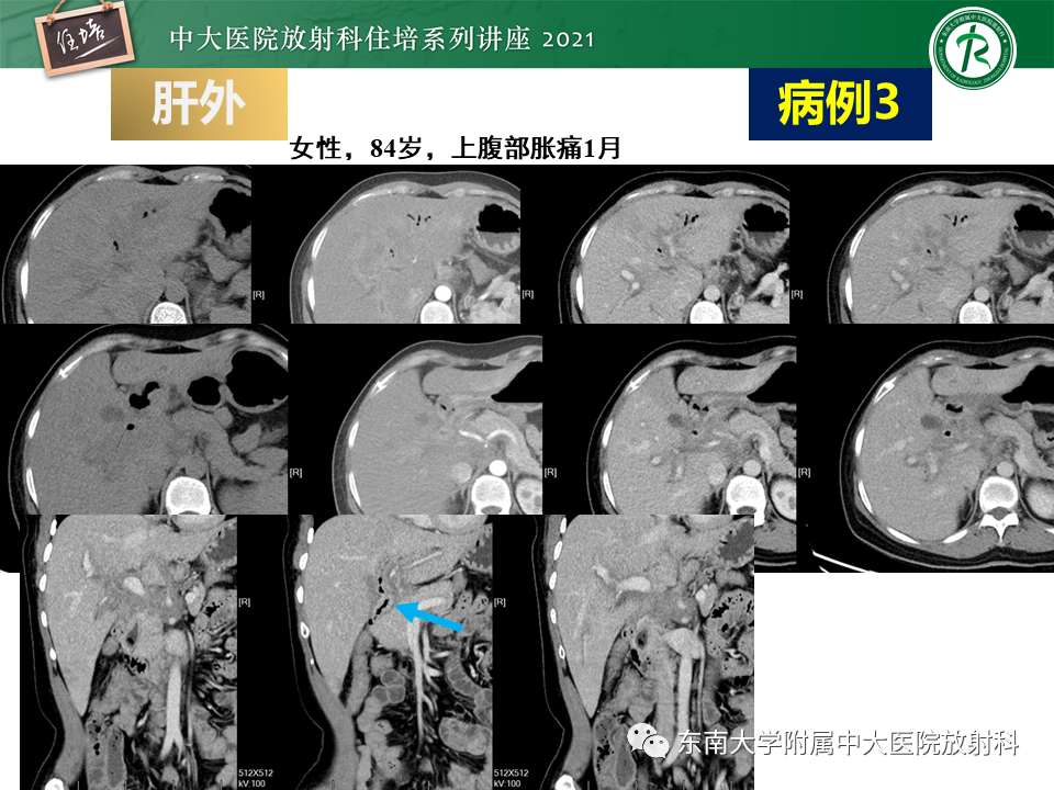 影像PPT - 【PPT】认识胆道系统影像常见漏诊、误诊病变-57