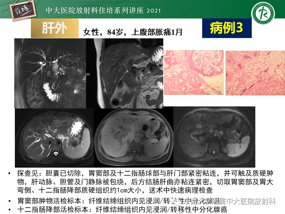 影像PPT - 【PPT】认识胆道系统影像常见漏诊、误诊病变-58