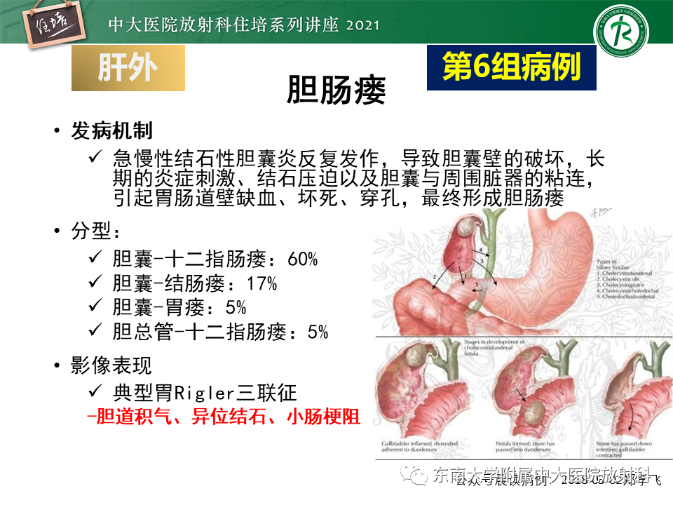 影像PPT - 【PPT】认识胆道系统影像常见漏诊、误诊病变-59