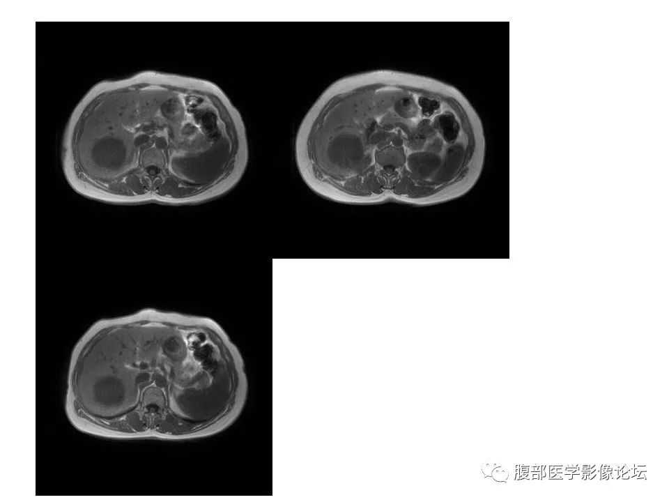 影像PPT - 【病例】肝脏淋巴瘤1例MR影像-2 影像PPT - 【病例】肝脏淋巴瘤1例MR影像-2