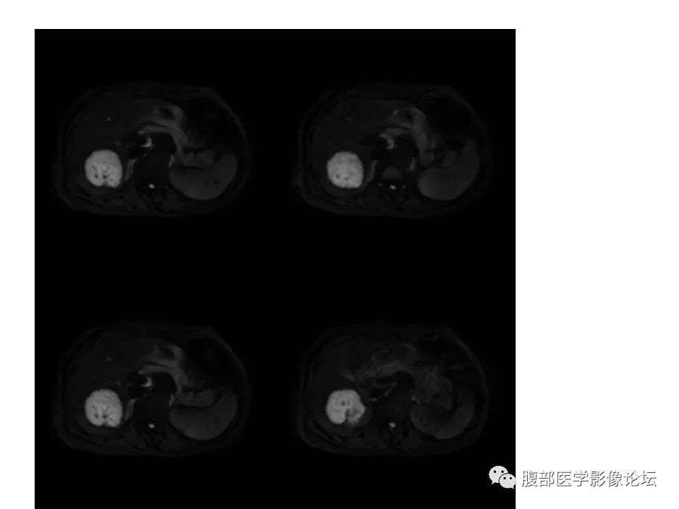 影像PPT - 【病例】肝脏淋巴瘤1例MR影像-4 影像PPT - 【病例】肝脏淋巴瘤1例MR影像-4