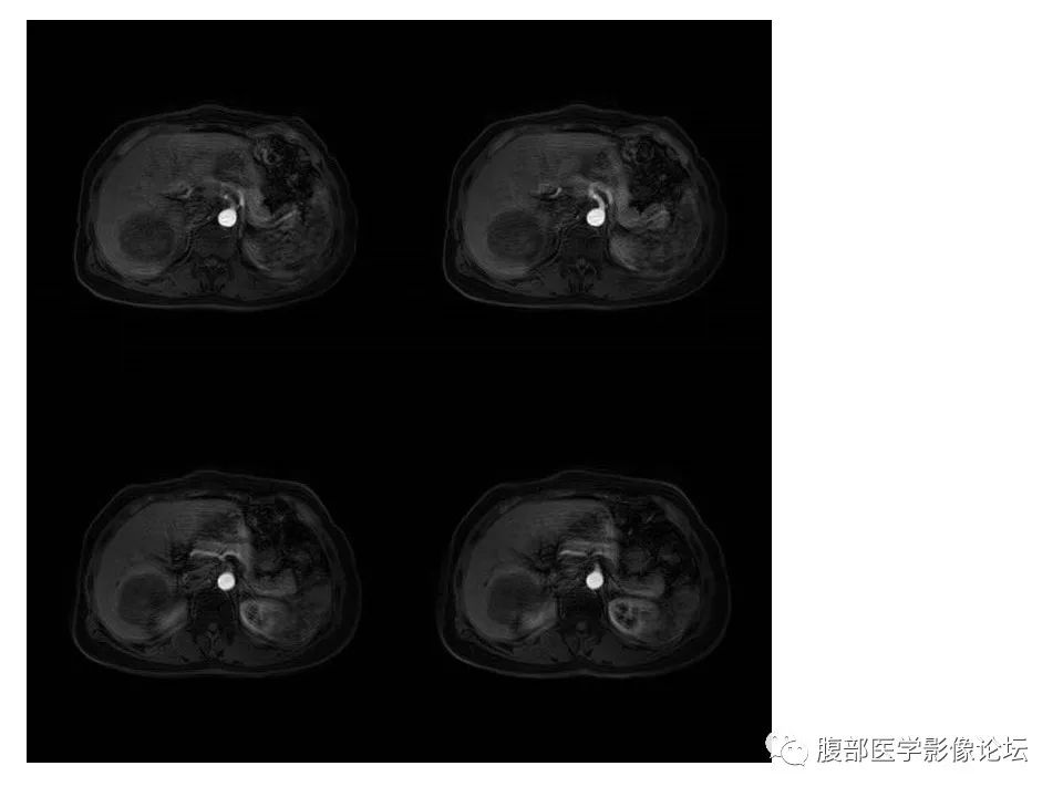 影像PPT - 【病例】肝脏淋巴瘤1例MR影像-5 影像PPT - 【病例】肝脏淋巴瘤1例MR影像-5
