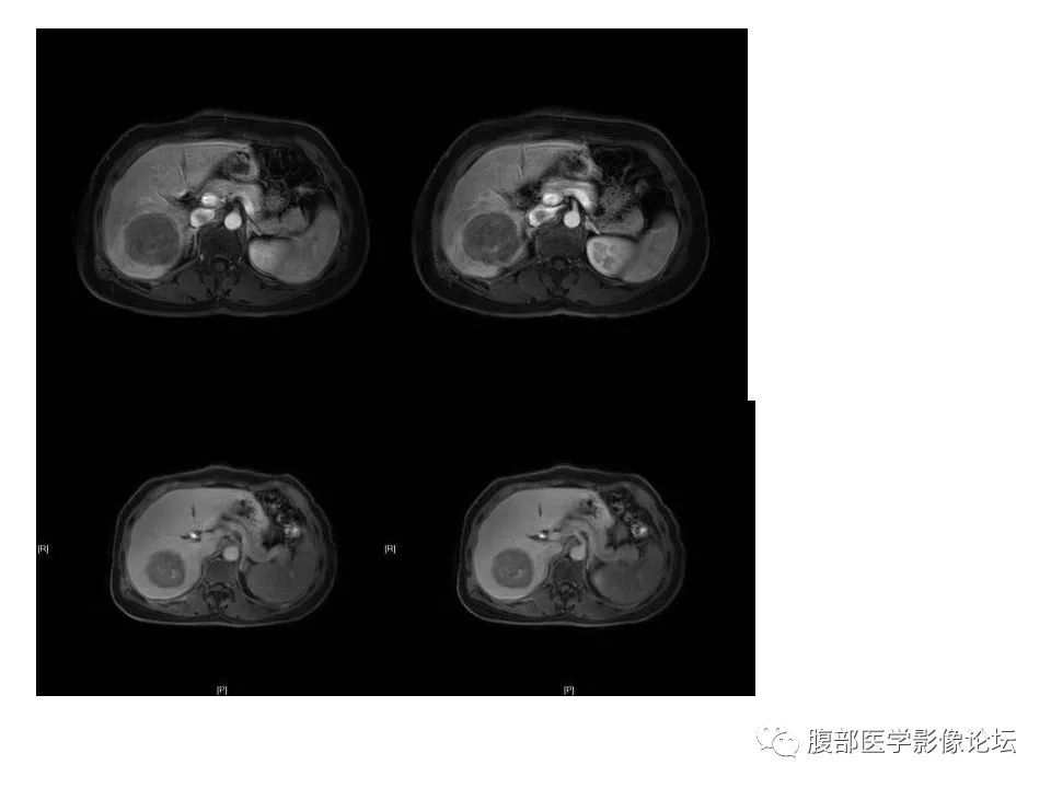 影像PPT - 【病例】肝脏淋巴瘤1例MR影像-6 影像PPT - 【病例】肝脏淋巴瘤1例MR影像-6