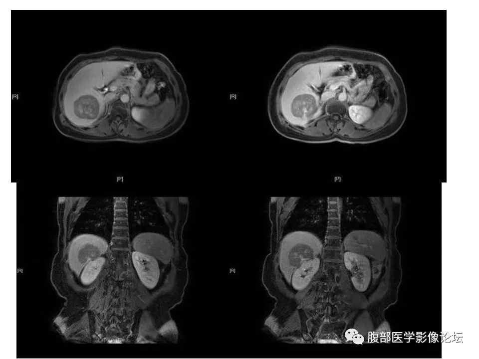 影像PPT - 【病例】肝脏淋巴瘤1例MR影像-7 影像PPT - 【病例】肝脏淋巴瘤1例MR影像-7