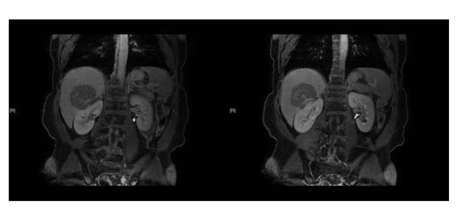 影像PPT - 【病例】肝脏淋巴瘤1例MR影像-8 影像PPT - 【病例】肝脏淋巴瘤1例MR影像-8