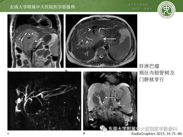 影像PPT - 【病例】肝脏淋巴瘤1例MR影像-15 影像PPT - 【病例】肝脏淋巴瘤1例MR影像-15