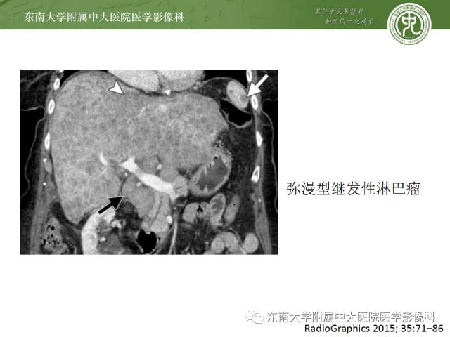 影像PPT - 【病例】肝脏淋巴瘤1例MR影像-16 影像PPT - 【病例】肝脏淋巴瘤1例MR影像-16