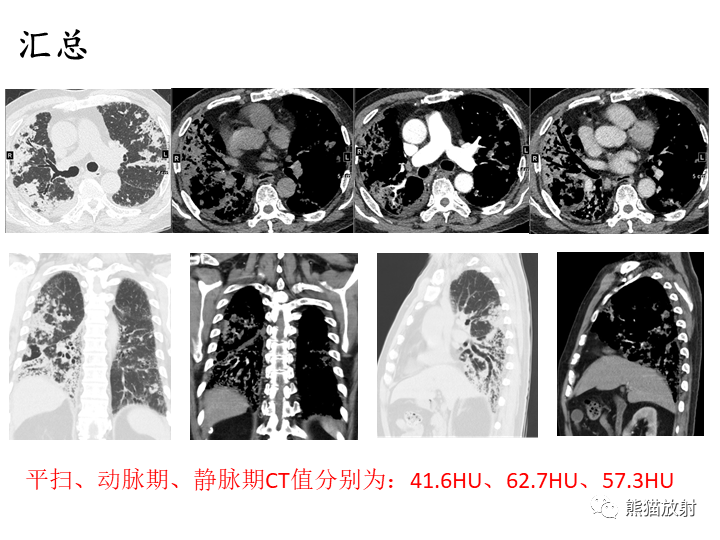 影像PPT - 【病例】肺粘液腺癌2例CT影像-11
