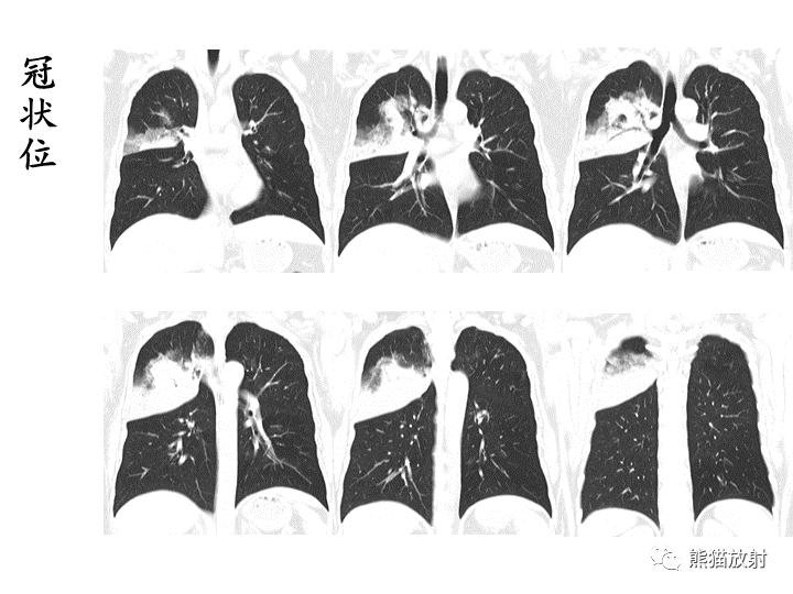 影像PPT - 【病例】肺粘液腺癌2例CT影像-18