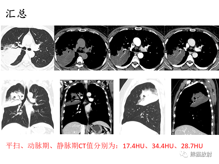影像PPT - 【病例】肺粘液腺癌2例CT影像-22