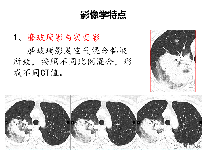 影像PPT - 【病例】肺粘液腺癌2例CT影像-27