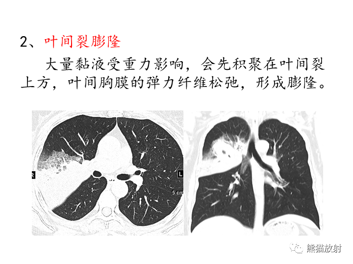 影像PPT - 【病例】肺粘液腺癌2例CT影像-28