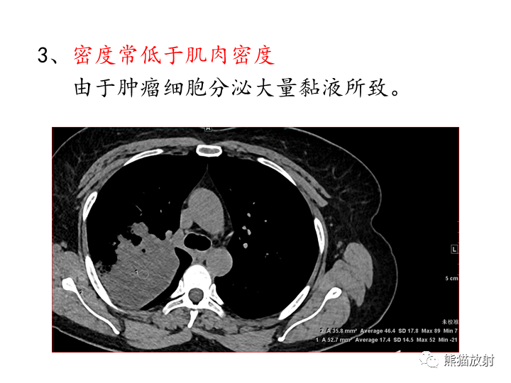 影像PPT - 【病例】肺粘液腺癌2例CT影像-29