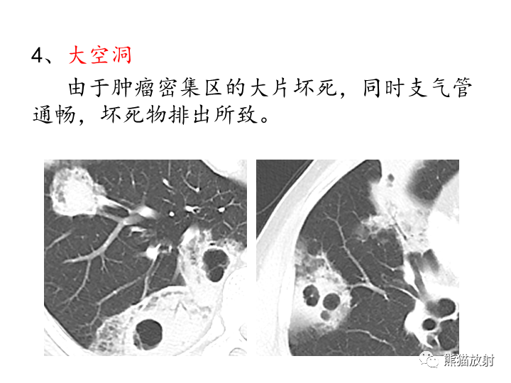 影像PPT - 【病例】肺粘液腺癌2例CT影像-30