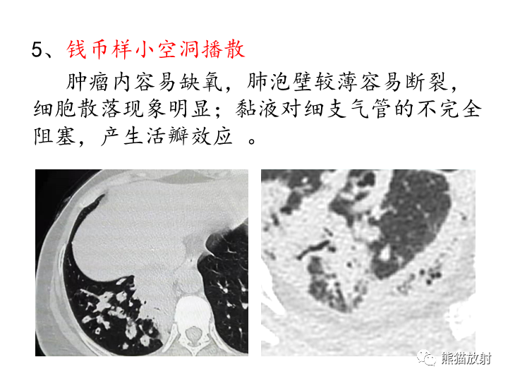 影像PPT - 【病例】肺粘液腺癌2例CT影像-31