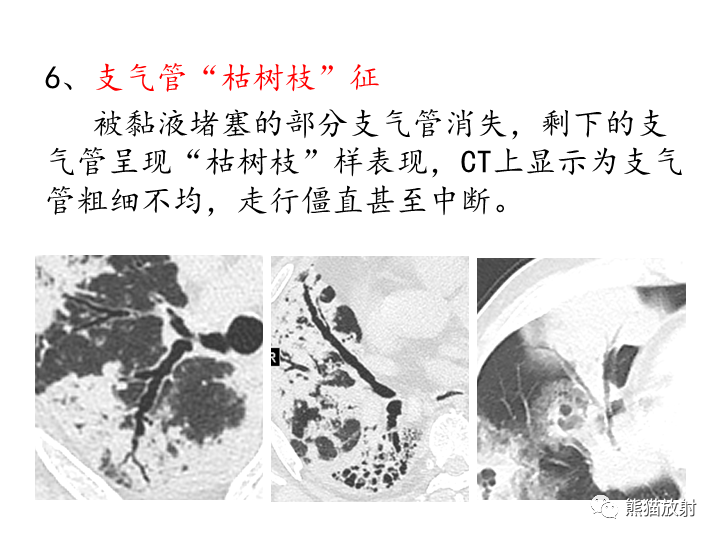 影像PPT - 【病例】肺粘液腺癌2例CT影像-32